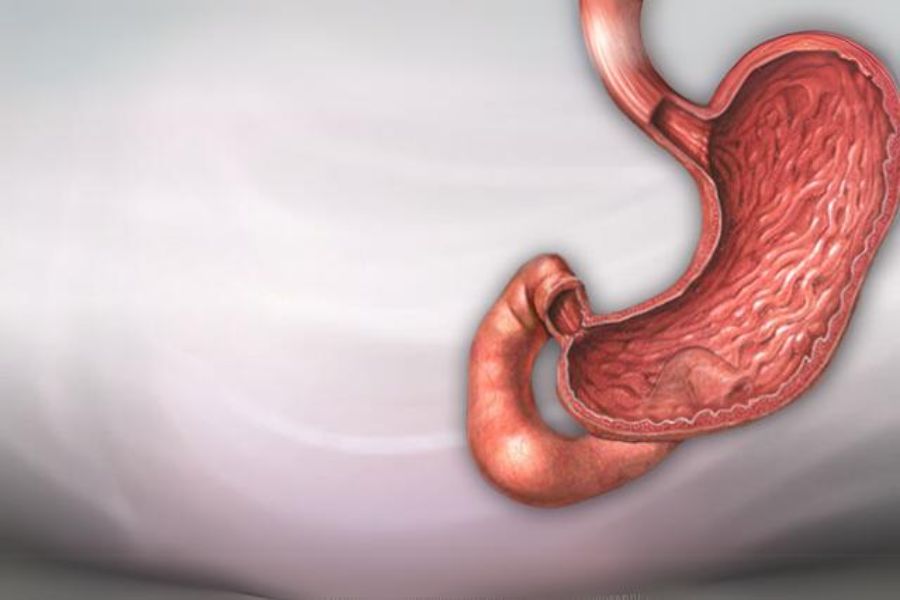 Duodenal Ulcer