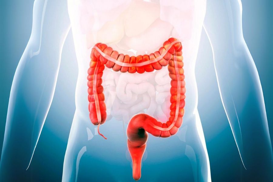 Irritable Bowel syndrome