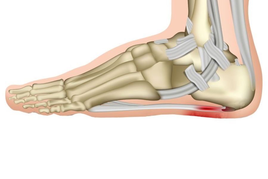 Planter fasciitis